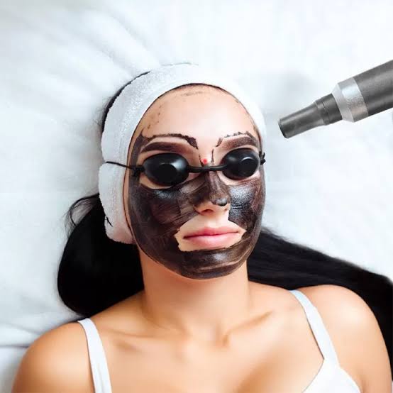 Hollywood Laser Carbon Peel