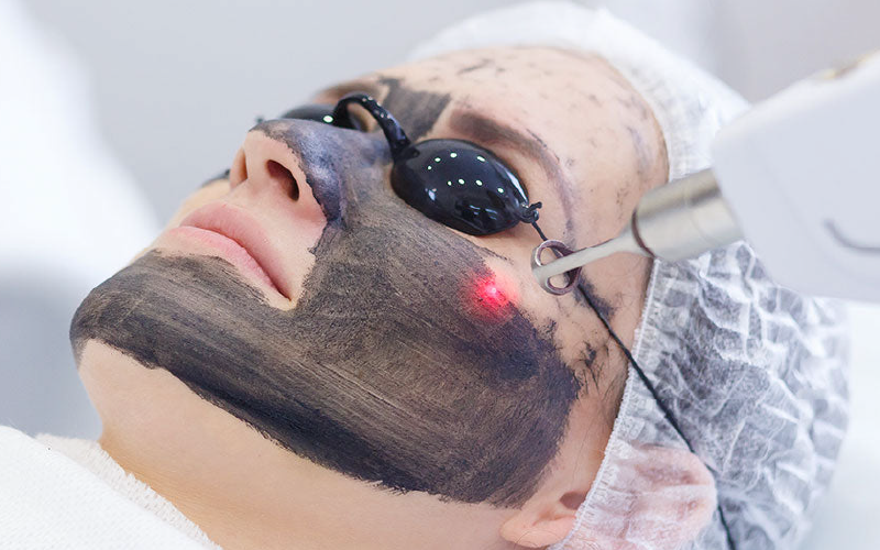 Hollywood Laser Carbon Peel
